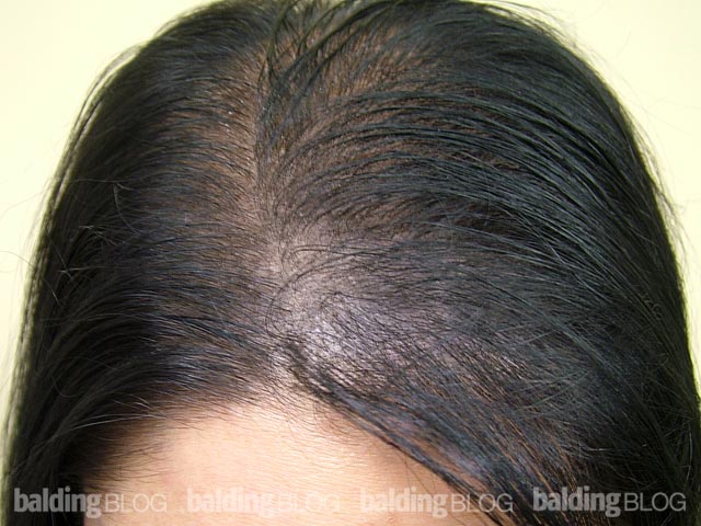 regrow hair surgery cost